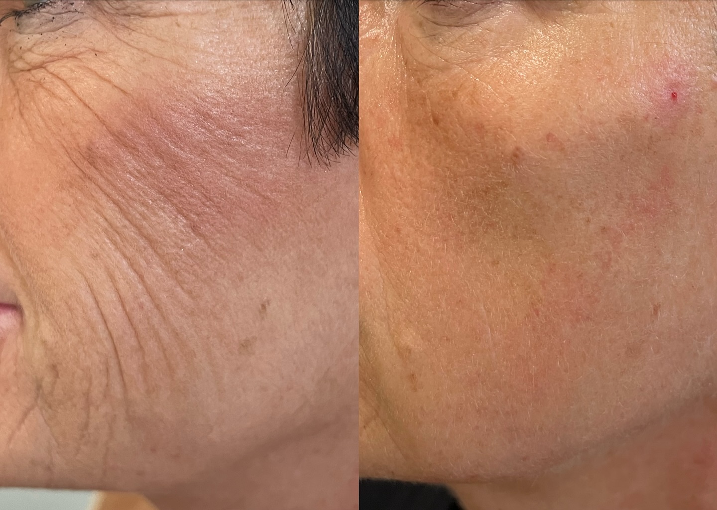 Redukcja zmarszczek – przed i po