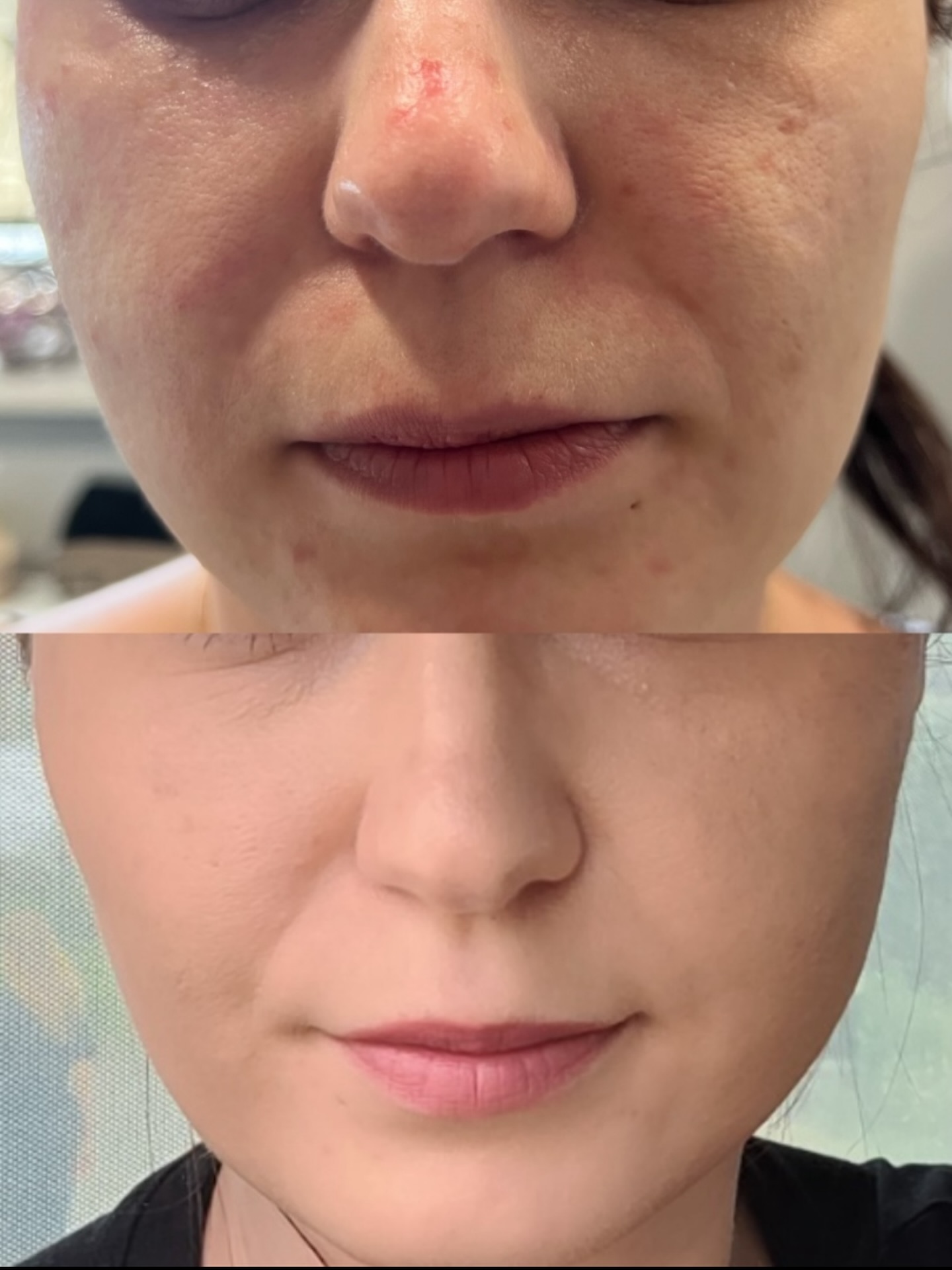 Zabieg na cerę – przed i po