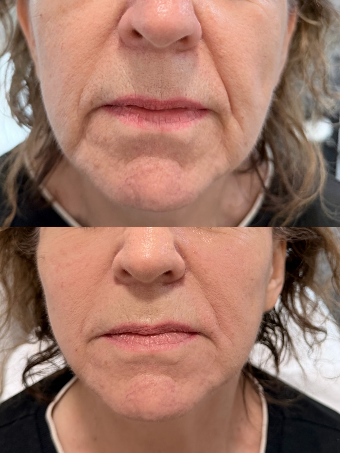 Lifting i modelowanie twarzy – przed i po